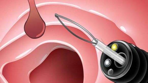 【健康解碼&middot;小貼士】檢查出息肉 需要切除嗎？